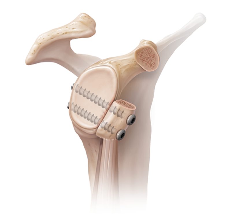 SHOULDER INSTITUTE